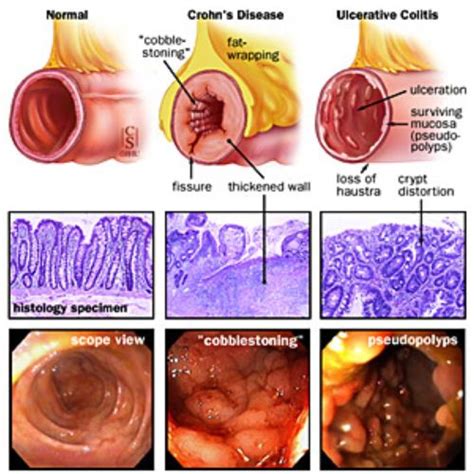 Ulcerative Colitis And Crohns Disease Crohns Disease Ulcerative