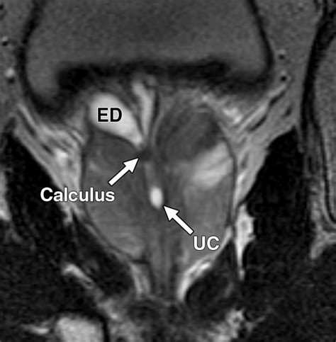 Endorectal Mri Of Prostatic And Periprostatic Cystic Lesions And Their Mimics Ajr