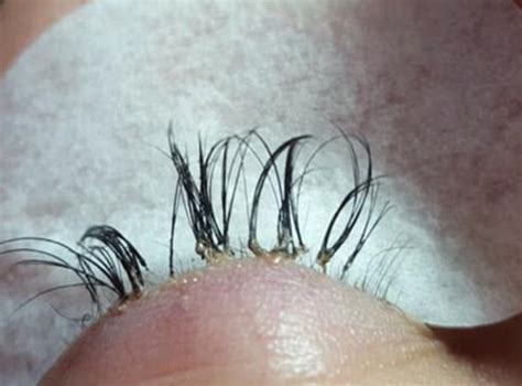 Beauty Expert Issues Warning After Womans Eyelash Extensions Cause Her
