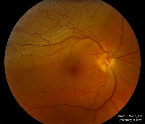 A torn retina usually has the same symptoms as a detached one. Non-Traumatic Monocular Vision Loss - Core EM