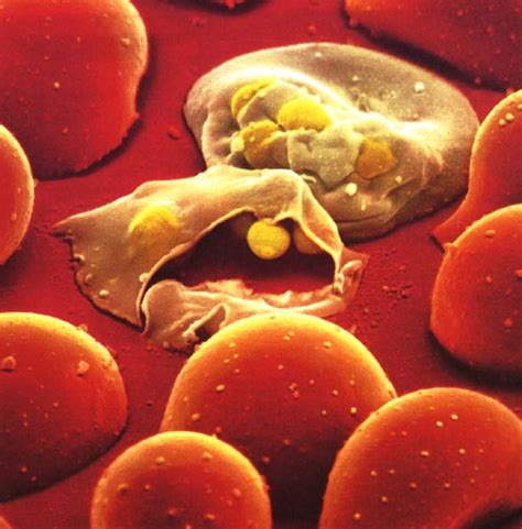 Majoritatea oamenilor sunt susceptibili la malarie. Under the Microscope: Secret Benefits of Thalassemia