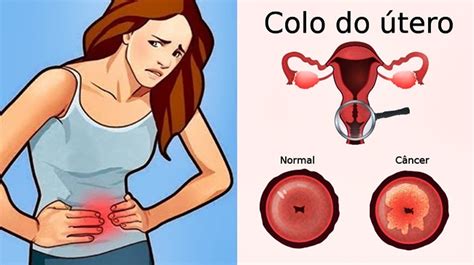 sintomas do câncer de colo de útero que não podem ser ignorados