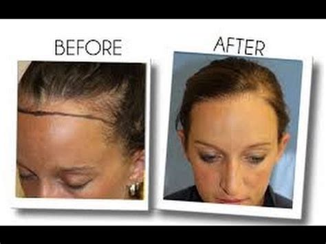 They say that you'll need to use it for life because it will fall out if you don't. Womens Hair Loss Treatment - Minoxidil ( Arganrain ) Before and After (15 Results) - YouTube