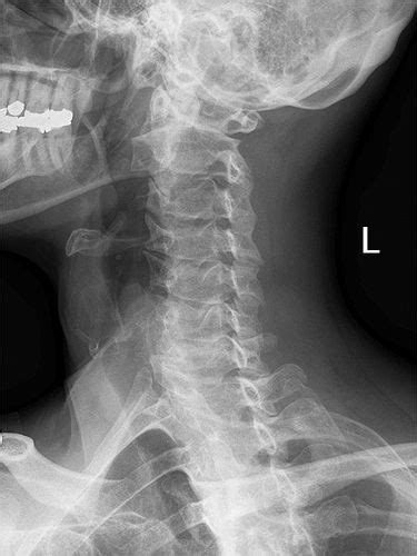 Cervical Spine Oblique Positioning Error Vintage Medical Radiology