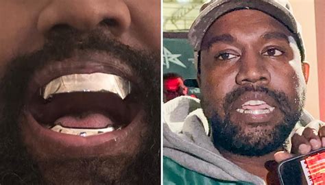 Kanye West Seemingly Replaces Teeth With Epic 139m Titanium