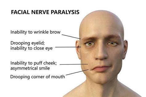 Facial Palsy Causes Symptoms Diagnosis And Treatment Public Health Notes