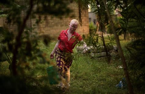An Island Refuge For Tanzanias Albinos Daily Sabah