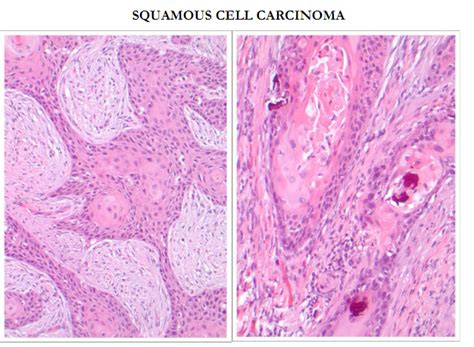Malignant Malignant Squamous Cell Carcinoma
