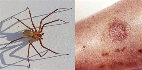 Trough Benign Alignment Spider Bite Treatment Ointment Participate