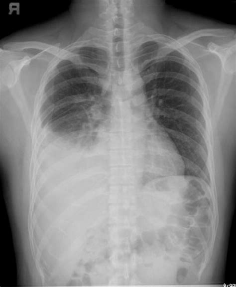 Chest Radiograph Demonstrating Right Sided Massive Pleural Effusion