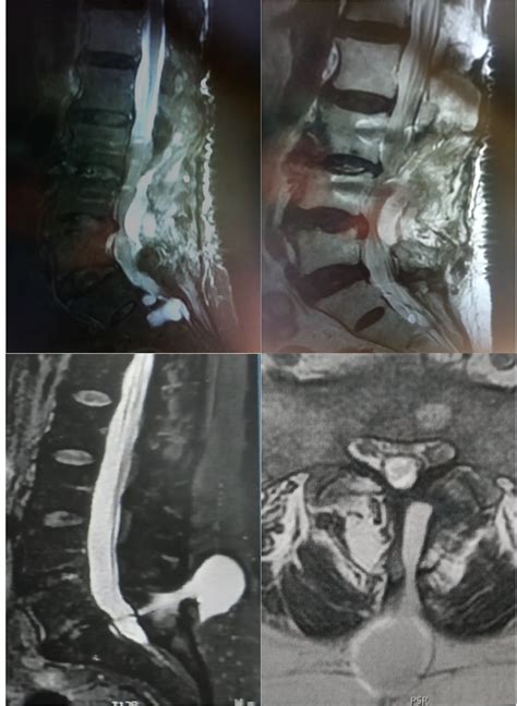 Complicaciones en la cirugía de hernia discal lumbar Parte 1