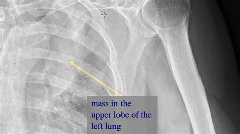 Features Of A Metastatic Bone Lesion On A Plain Radiograph Youtube
