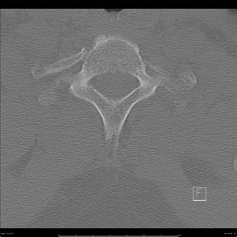 Bilateral Cervical Ribs Radiology Case Radiology