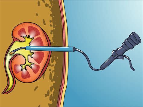 3 Ways To Pass A Kidney Stone Wikihow