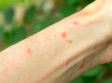 What Does Poison Ivy Rash Look Like On The Body