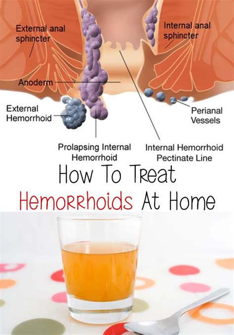 Pin On Hemorrhoids