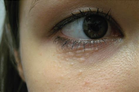 Can You Identify The Papules Below This Womans Eyes Consultant360