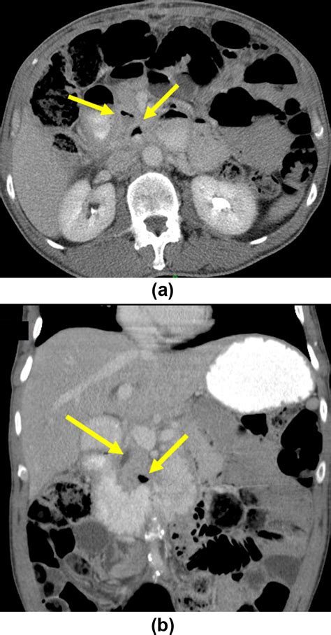 Duodenal Diverticula Potential Complications And Common Imaging
