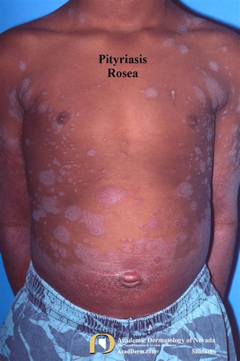 Pityriasis Rosea It Starts With A Herald Patch Academic Dermatology Of Nevada