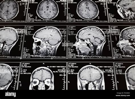 Mri Scan Of Brain High Resolution Stock Photography And Images Alamy