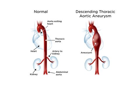 Aortic Aneurysm My Doctor Online