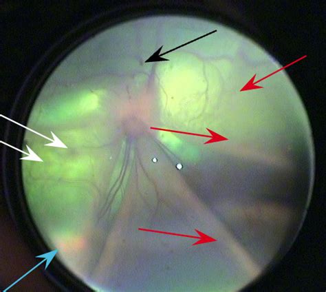 Retinal detachment happens when the retina separates from the eyeball's innermost lining.2 x research source there are numerous causes of retinal detachment in the cat but acute trauma is. Feline Fundus Diseases Image Gallery | Clinician's Brief