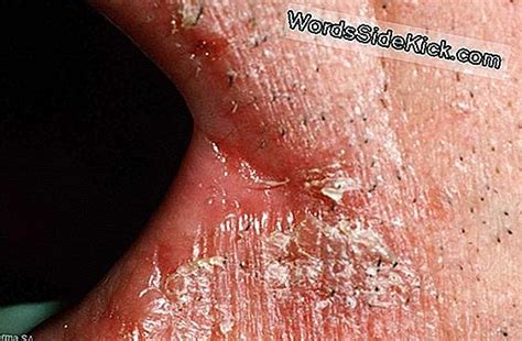 Symptoms of hantavirus infection, including hantavirus pulmonary syndrome plus causes, treatments and other facts. Hantavirus: Symptomen & Behandeling Van Infectie - 2021 ...