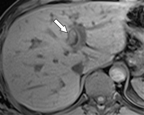 Uncommon Intraluminal Tumors Of The Gallbladder And Biliary Tract