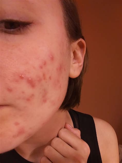 Adult Cystic Acne That Nothing Touches What Am I Missing Here