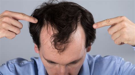 Hair Loss Creates Signs And Symptoms Treatments Grow Brand New Hair Educa City