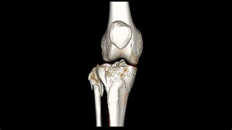 Tibial Plateau Fracture Surgery Wikidoc