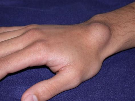 Ganglion Cyst Of Hand And Wrist Treatment By Raleigh Hand Center Raleigh Hand Center