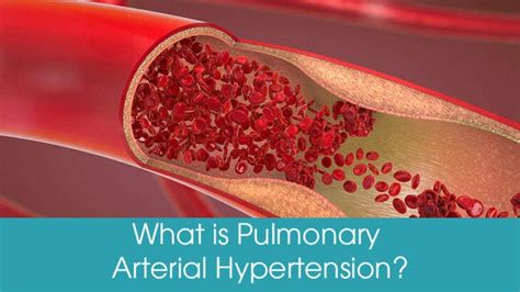 What Is Pulmonary Arterial Hypertension Symptoms And Causes