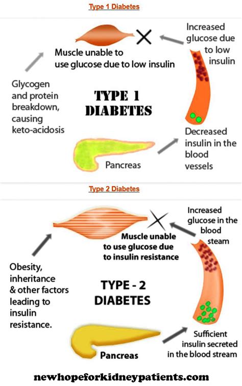 Chronic kidney disease (ckd) is common in people with both type 1 and type 2 diabetes. NHFKP | A new hope for kidney patients!
