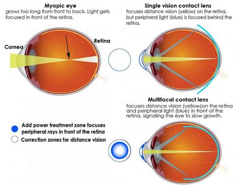 Multifocal Contact Lenses Slow Progression Of Nearsightedness In Children