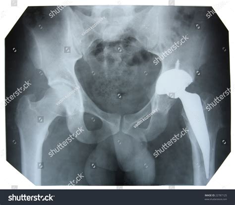 Xray Picture Showing Male Pelvis Artificial Stock Photo 22787125