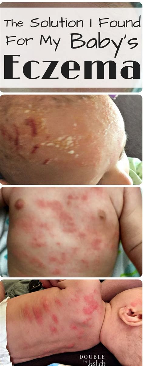 Eczema On Babies What We Did For My Infants Eczema That Worked