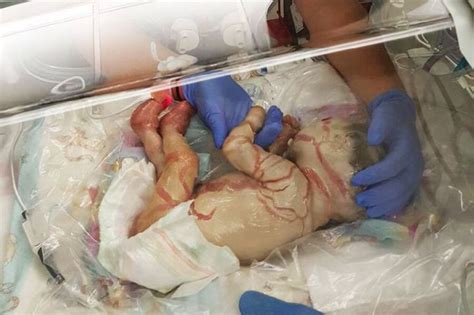 Baby Girl Born With Skin Condition That Covers Her In Scales Defies