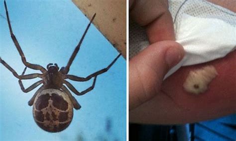 Two Treated In Hospital After Being Bitten By Poisonous False Widow