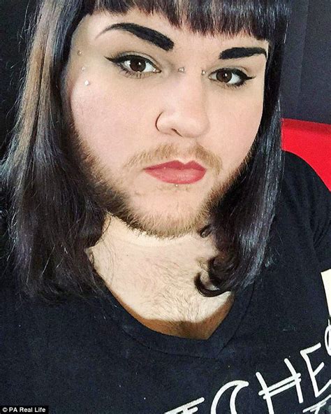 Woman With Pcos Grows A Full Beard After Finding Love With A Model