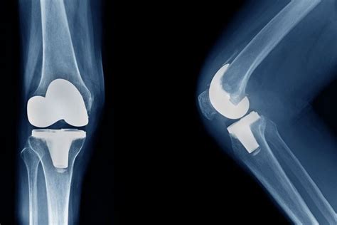 Aimed Welcomes Govts Move To Cap Prices Of Orthopaedic Knee Implants