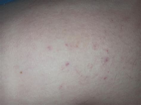 What Are These Red Dots On My Thigh Rdermatology