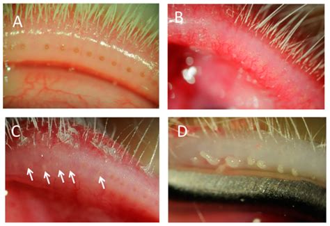 Vision Free Full Text A Novel Model Of Meibomian Gland Dysfunction