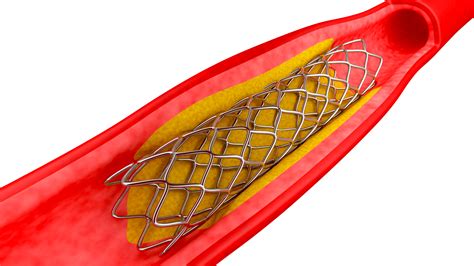 Stent In The Heart