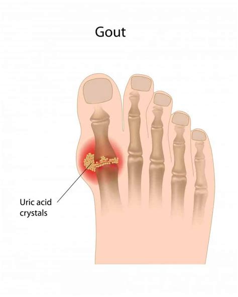 Gout Red Hot Swollen Big Toe Joint Beaver Valley Foot Clinic