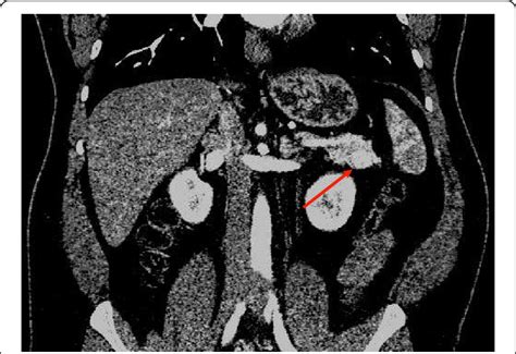 Triple Phased Abdominal Computed Tomography Scan Arterial Phase