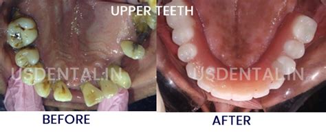 What Is The Best Treatment Option For A Loose Tooth Us Dental