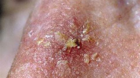 Rakovina Kůže Vyrážka Svědění A Symptomy