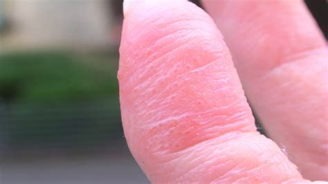 Learn About Dyshidrosis What Is Eczema On Hands Youtube