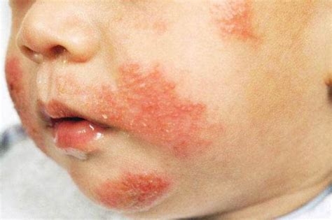 Infant Rash Around Mouth Pictures Photos